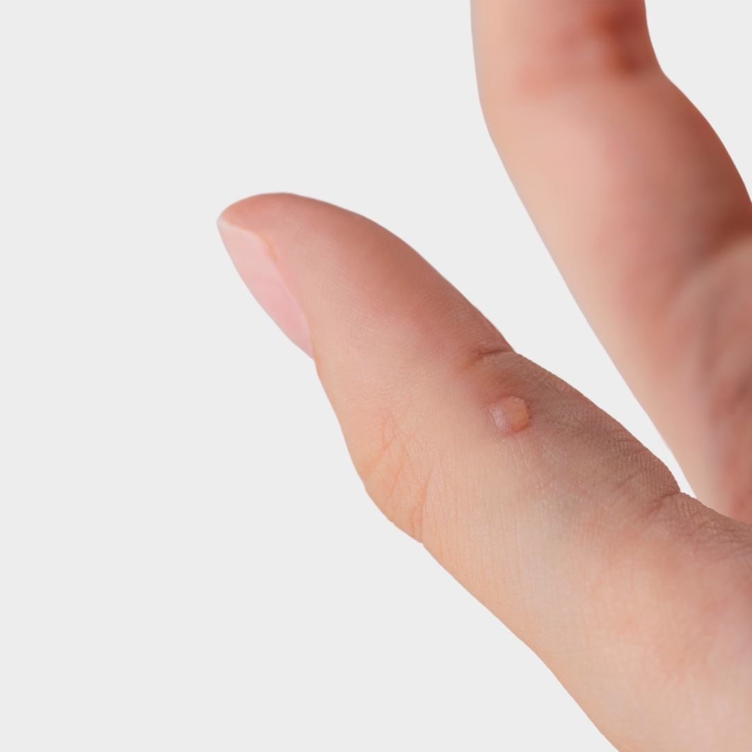 Hand Wart Removal Treatment | London Wart Clinic