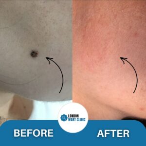 Successful removal of a facial wart, with clear skin post-treatment.