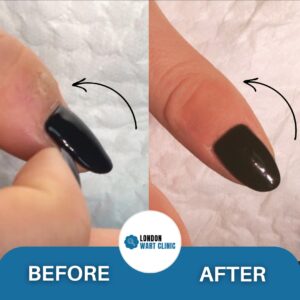 Showing smooth skin following the removal of a hand wart.
