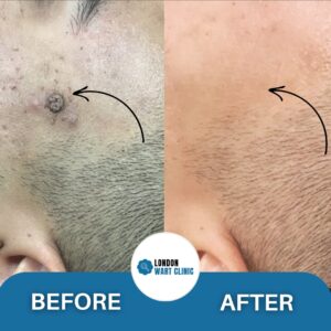 Wart removal from the face, demonstrating a scar-free outcome.