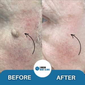 Effective wart removal from the face, resulting in even-toned, smooth skin.
