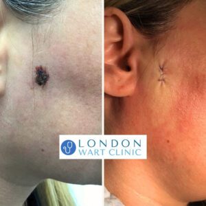 Skin growth on face