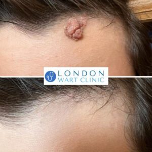 Wart on forehead