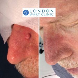 Wart on nose